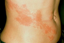 shingles
